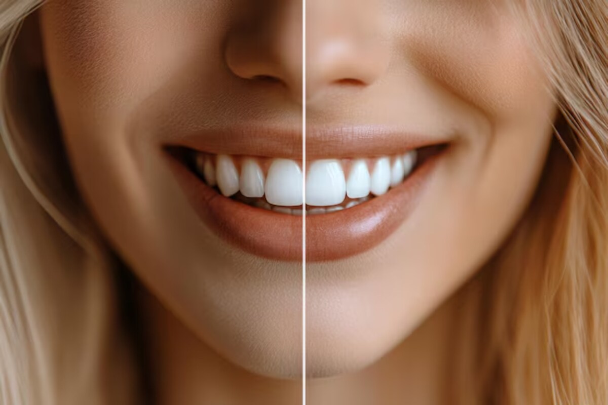 how to choose the right place for teeth whitening